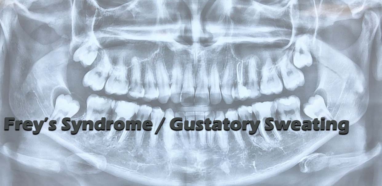 Frey’s Syndrome / Gustatory Sweating
